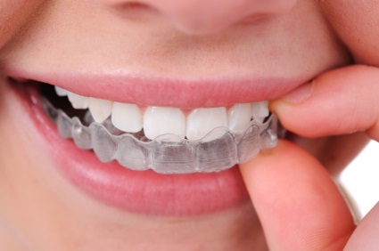 Clear Aligner Clear Aligner